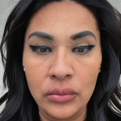 PDO Full Face Lifting Threads - La Clinique Aesthetics