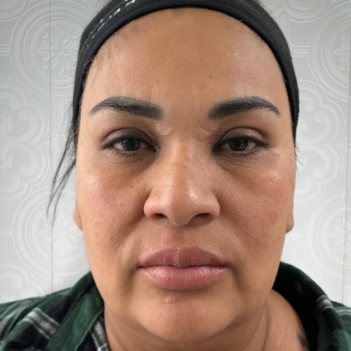 PDO Full Face Lifting Threads - La Clinique Aesthetics